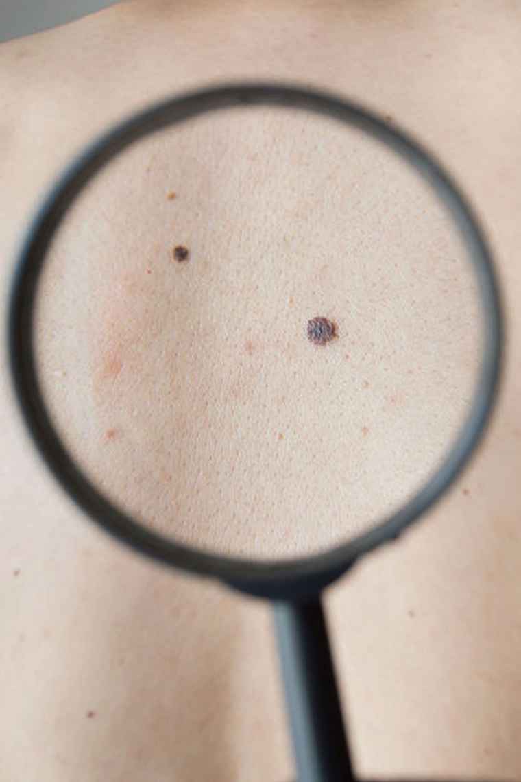 SKINCANCERREMOVAL Nova Dermatology