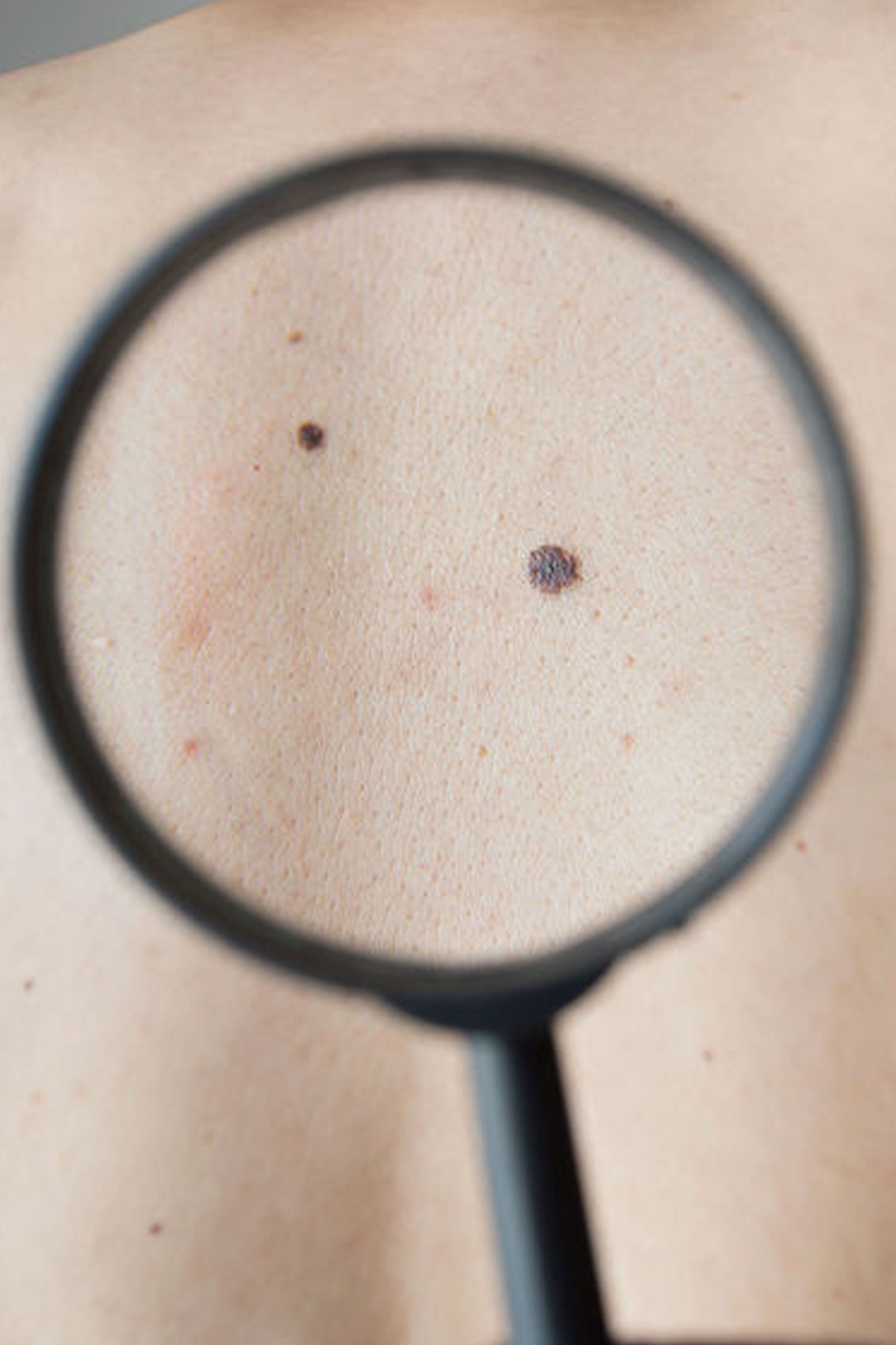 Reconstructive Procedures: skin cancer removal