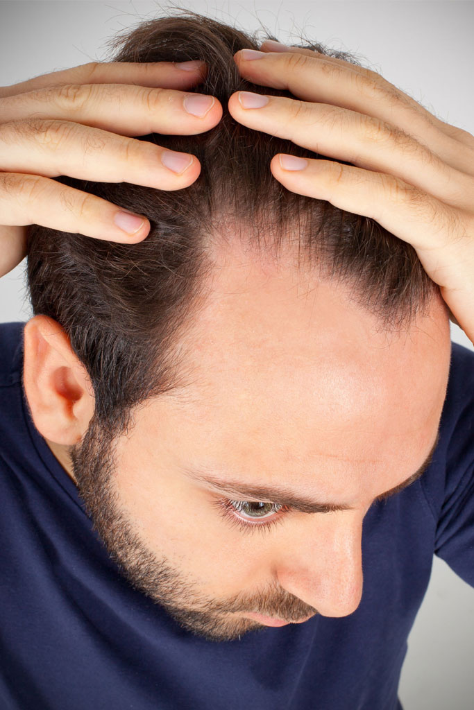 Hair Loss in Women  Forefront Dermatology